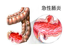 上海胃肠病医院 急慢性肠炎