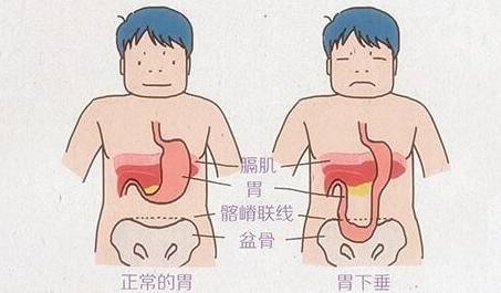 胃下垂的症状是什么